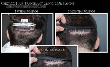 Hair transplantation surgery before and after pictures