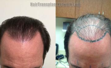 Hair restoration procedure before and after results