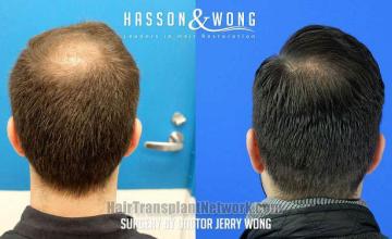 Surgical hair transplantation result photographs