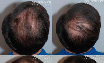 Hair restoration procedure before and after pictures