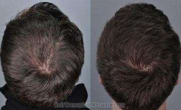 Hair transplantation surgery before and after pictures