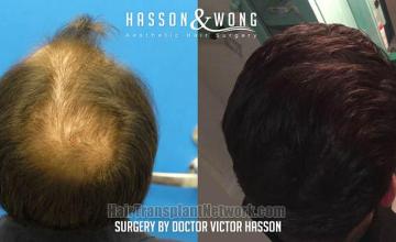 Hair transplantation procedure before and after photographs