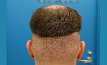 Hair transplantation surgery before and after photos