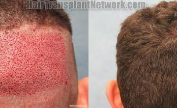 Hair transplantation procedure before and after photographs