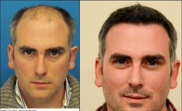 Hair restoration procedure before and after results