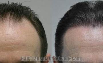 Hair restoration procedure before and after results