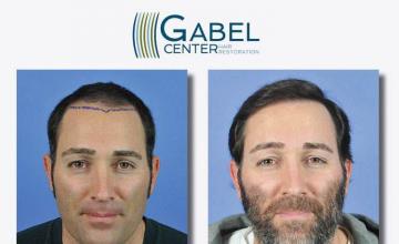 Hair restoration procedure before and after results