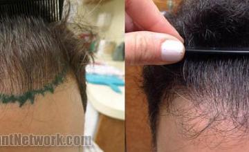 Front view - Before and after hair transplantation surgery