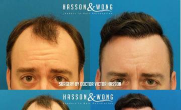 Before and after hair restoration procedure images