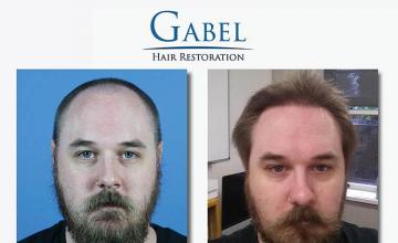 Before and after hair restoration procedure images