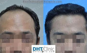 Front view - Before and after