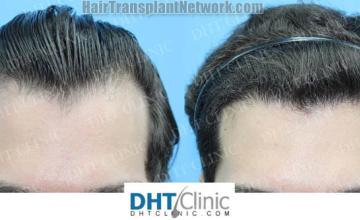 Front view - Before and after hair restoration procedure