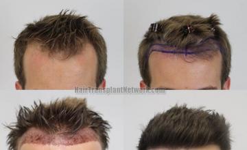 Front view - Before and after