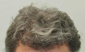 Hair restoration surgery result photos 10 months postoperative