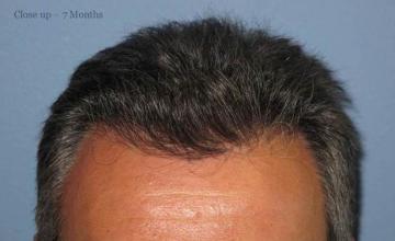 Hair restoration surgery before and after photos