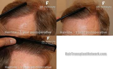 Hair restoration surgery after photos