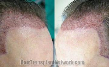 Hair restoration procedure before and after pictures