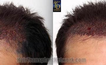 Hair transplantation surgery before and after pictures