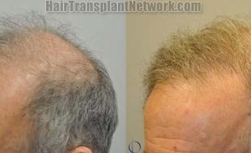 Before and after surgical hair restoration images