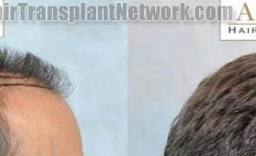 Before and after hair replacement surgery procedure