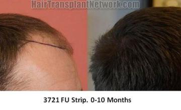 Hair transplantation surgery before and after photos