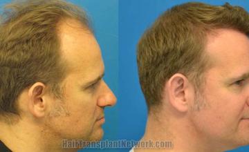 Hair transplantation surgery before and after images