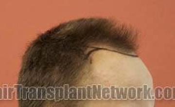 Hair transplantation surgery before and after photos