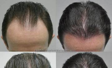 Hair transplantation surgery before and after photos