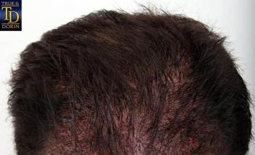 Hair restoration procedure before and after pictures