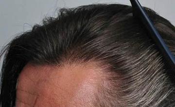 Hair transplantation surgery before and after images