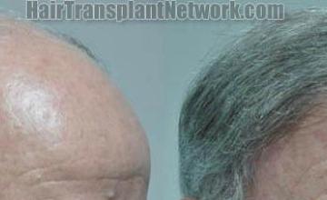 Hair transplantation surgery before and after images