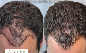 Top view before and after hair transplantation procedure 