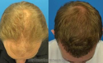 Hair transplantation surgery before and after photos