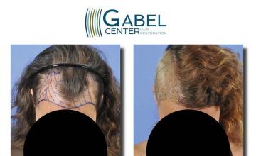 Hair transplantation surgery before and after pictures