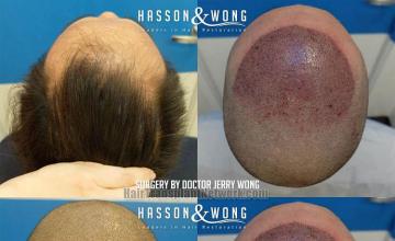 Surgical hair transplantation result photographs