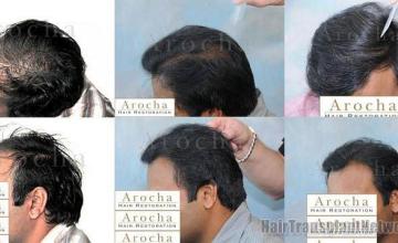 Left side photos of before and after hair transplant