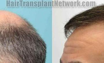 Hair restoration procedure before and after results