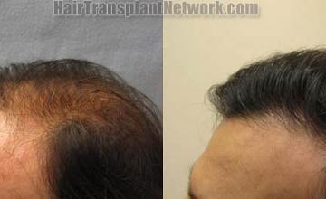 Hair transplantation surgery before and after photos