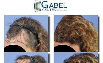 Hair transplantation surgery before and after photos