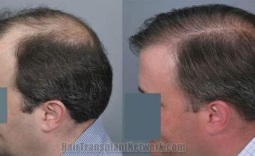 Hair transplantation surgery before and after pictures