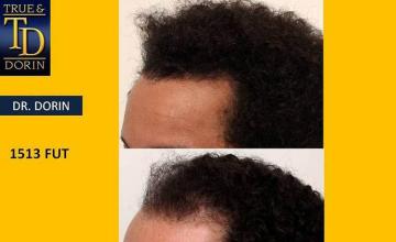 Hair transplantation surgery before and after photos