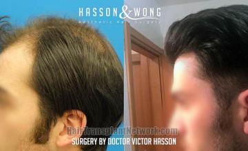 Hair restoration procedure before and after pictures