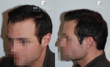 Hair transplant surgery before and after photos