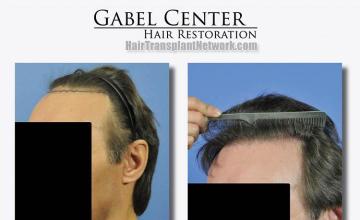 Hair restoration surgery before and after images