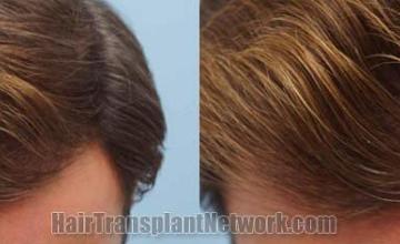 Hair transplantation surgery before and after pictures