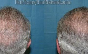 Back view after hair transplantation photographs