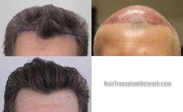 Hair restoration procedure before and after results