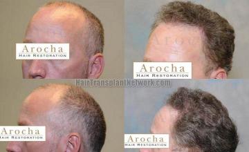 Left view - hair restoration before and after pictures