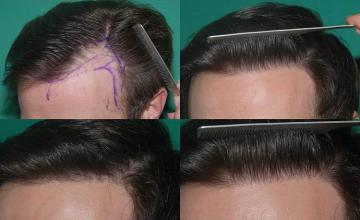 Hair restoration procedure before and after pictures