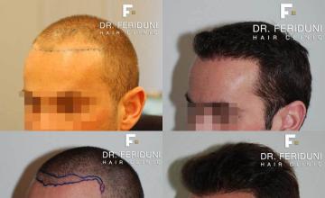 Hair transplantation surgery before and after images